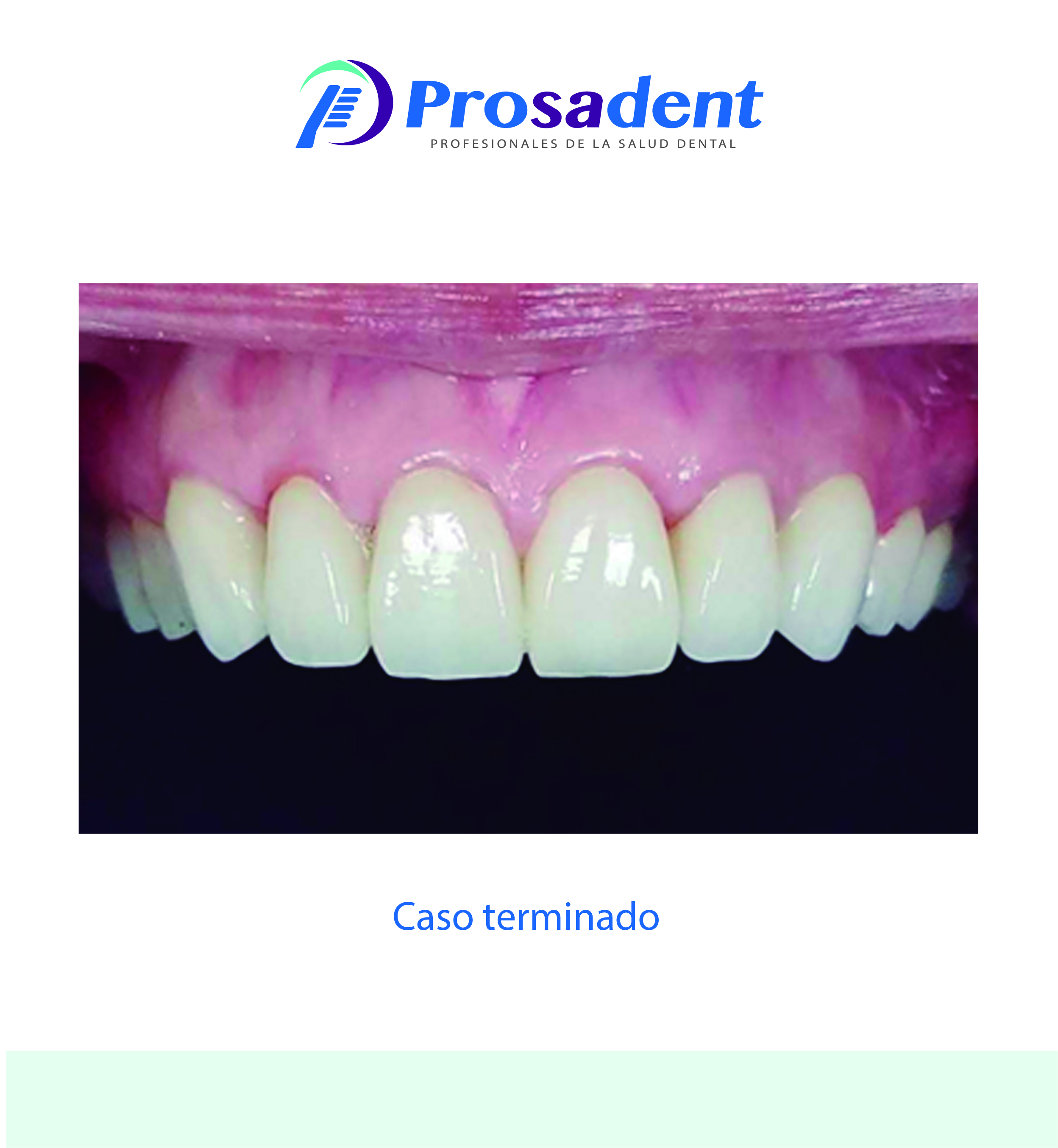 Tratramiento 3